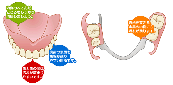 入れ歯（入れ歯）の清掃のポイント