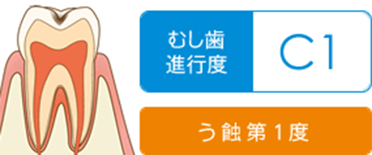 歯の表面のエナメル質が溶けてきます。痛みは有りませんが、黒っぽく変色してきます。