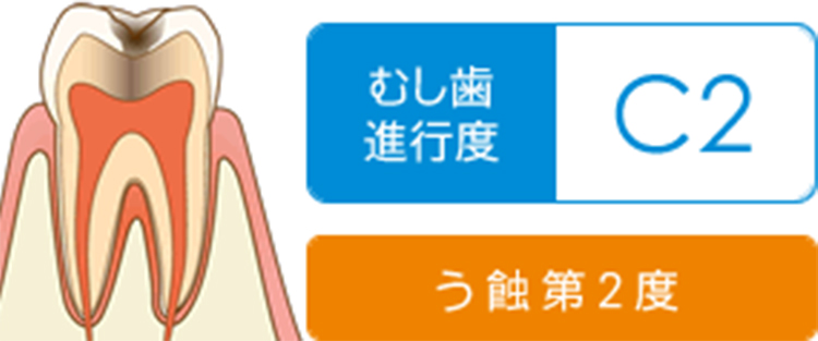 歯の内側の象牙質まで進行し、穴が開いている状態です。冷たいものなどで歯がしみることがあります。