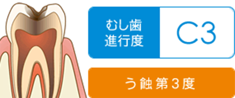 むし歯の穴が拡大し、歯髄(神経)まで進行した状態です。場合によっては激しく痛みます。