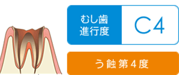 歯が溶け根元部分だけ残った状態です。このまま放置すると歯周病になる危険性もあります。